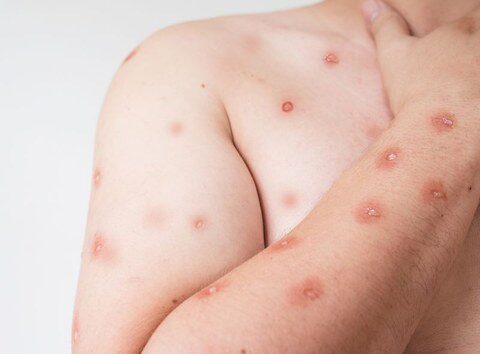Mpox
